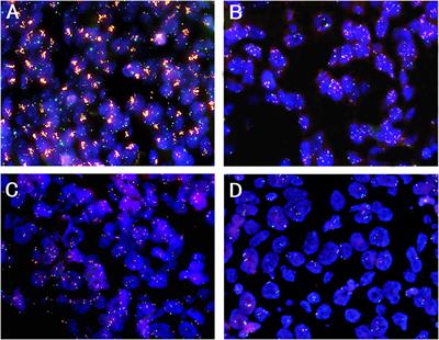 CDK4 Amplification in Esophageal Squamous Cell Carcinoma Associated With Better Patient Outcome